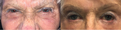 Botox before and after photo