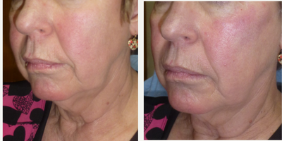 Voluma before and after photo