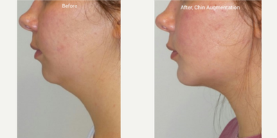 Chin Implant before and after photo