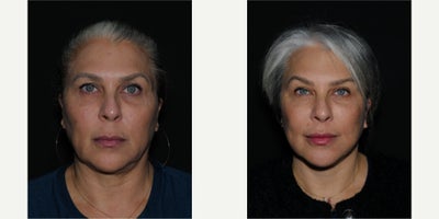before and after image