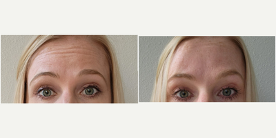 Dysport before and after photo