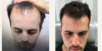 FUE Hair Transplant before and after photo