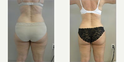 Liposuction before and after photo