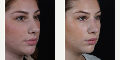 Rhinoplasty before and after photo