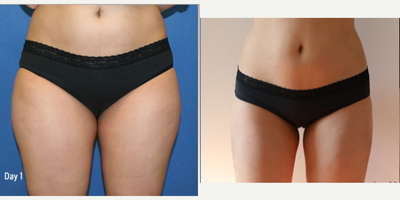 Smart Lipo before and after photo