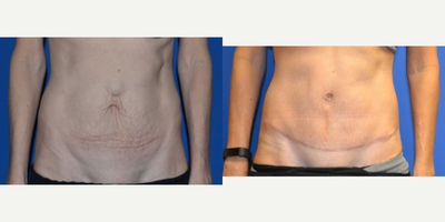 Tummy Tuck before and after photo