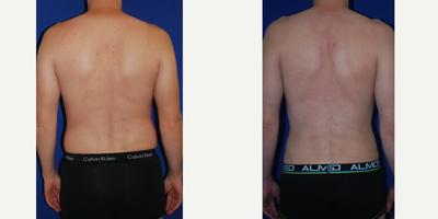 Vaser Liposuction before and after photo