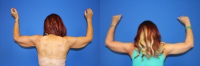 Arm Lift before and after photo