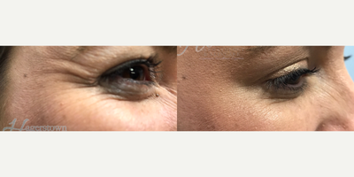 Botox before and after photo