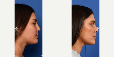 Botox before and after photo