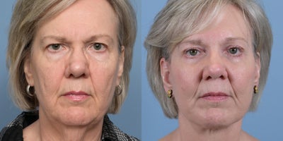 Brow Lift before and after photo