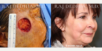 Facial Reconstructive Surgery before and after photo
