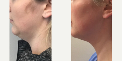 Kybella before and after photo