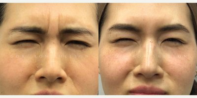 Skin Tightening before and after photo