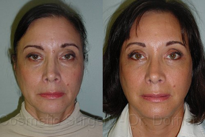Facelift before and after photo
