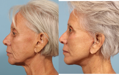 Facelift before and after photo