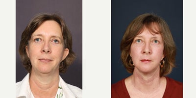 Facelift before and after photo