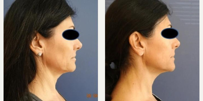 Fractora RF before and after photo