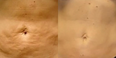 Velashape before and after photo