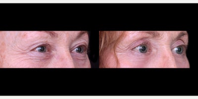 Eyelid Surgery before and after photo