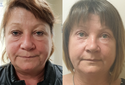 Eyelid Surgery before and after photo