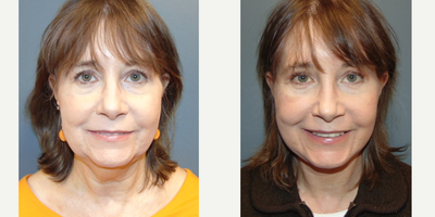 Facelift before and after photo