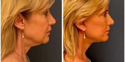 Facelift before and after photo