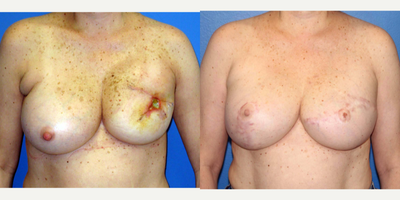 Breast Reconstruction before and after photo