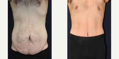 Tummy Tuck before and after photo