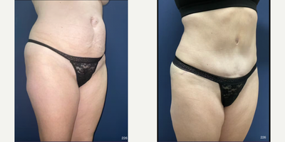 Tummy Tuck before and after photo