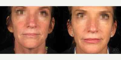 Bellafill before and after photo