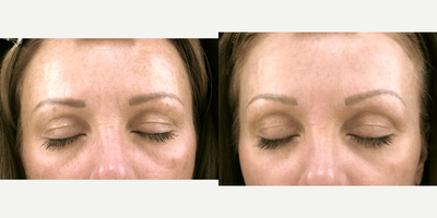 Botox before and after photo