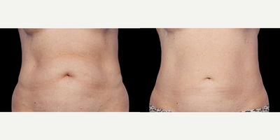 CoolSculpting before and after photo