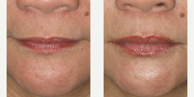 Lip Fillers before and after photo