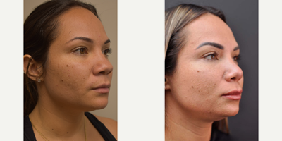 Rhinoplasty before and after photo