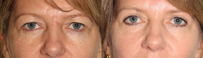 Belotero before and after photo