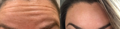 Botox before and after photo