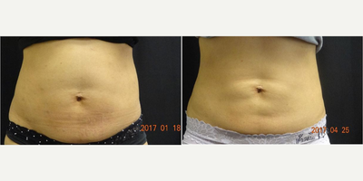 CoolSculpting before and after photo