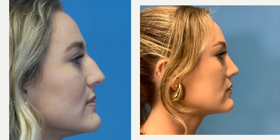 Rhinoplasty before and after photo