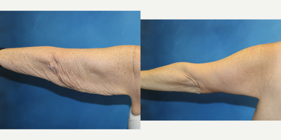 Arm Lift before and after photo