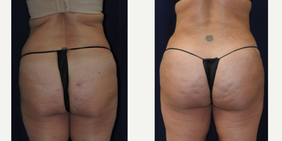 Brazilian Butt Lift before and after photo