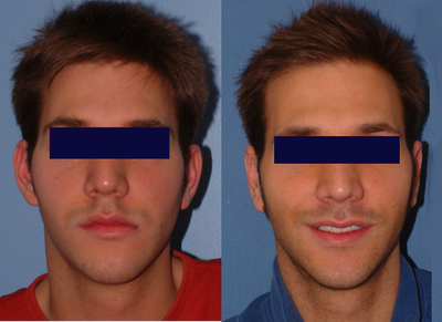 Ear Surgery before and after photo