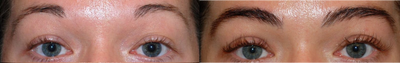 Eyebrow Transplant before and after photo
