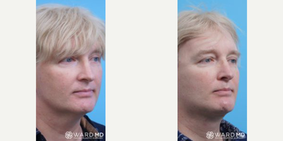 Facelift before and after photo