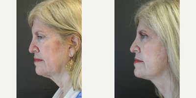 Mini Facelift before and after photo