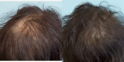 Scalp Micropigmentation before and after photo