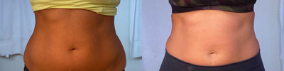 Vanquish before and after photo