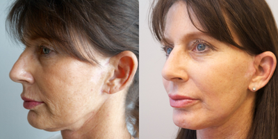 Facelift before and after photo