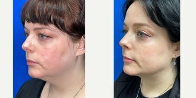 Liposuction before and after photo