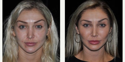 Liposuction before and after photo